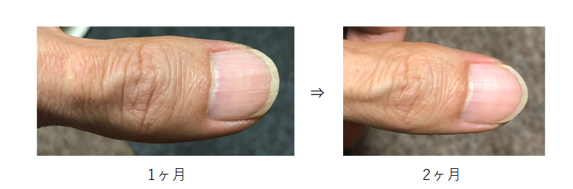 親指の爪の経過